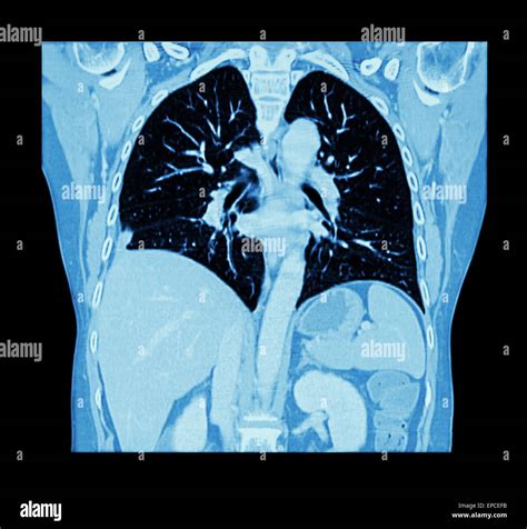 Lung Cancer Ct Scan Of Chest And Abdomen Show Right Lung Cancer