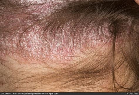 Stock Image Dermatology Scalp Psoriasis Extensive Dry Pink Area With