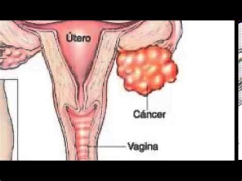 ¿qué es el cancer de utero? Síntomas del cáncer de útero - Principales síntomas del ...