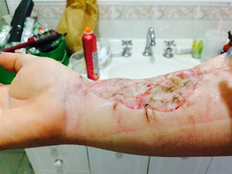 Jodie Dominy Shares Photos Of Lump That Turned Into Rare Skin Cancer