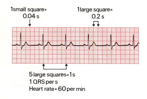 Standard Ecg Tracing Of Sinus Rhythm Ekg Sinusitis Heart Rate