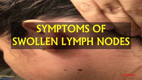 Swollen Lymph Nodes Symptoms