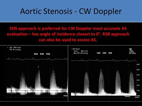 Aortic Stenosis Ultrasound