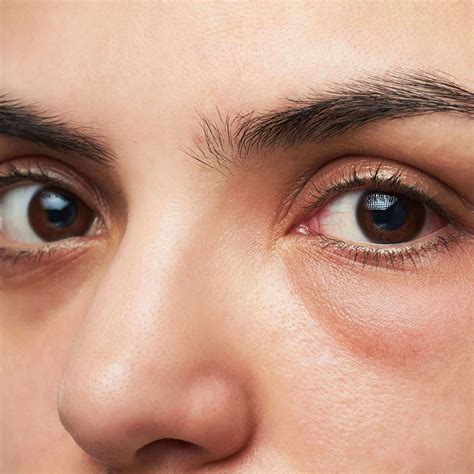 Under Eye Dark Circles And Puffiness The Causes And Treatments