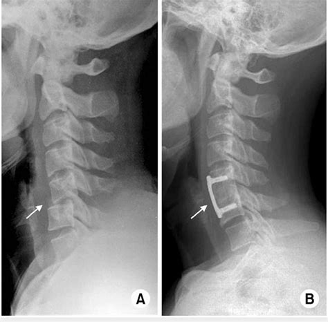 C5 6 Unilateral Facet Joint Dislocation Lateral Radiographs Of The