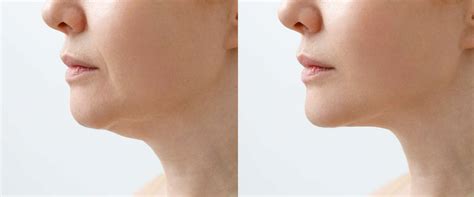 Understanding And Treating The Appearance Of Jowls Reviva Labs