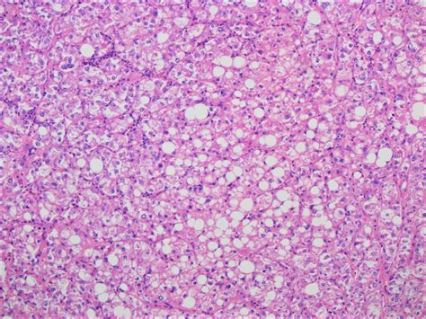 Pathology Outlines Hcc Steatohepatitic