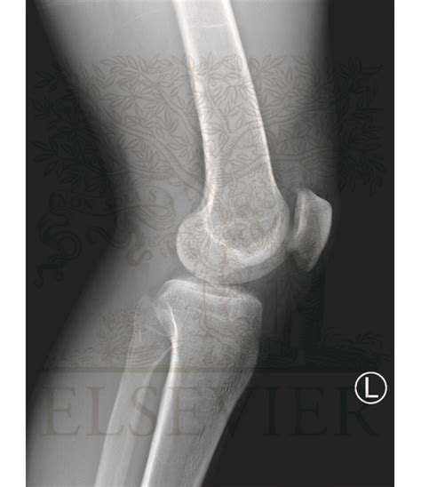 Lateral Knee Radiograph Anatomy
