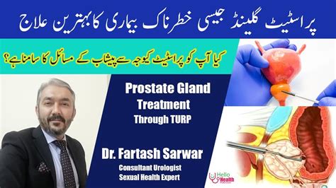Prostate Gland Ka Ilaj Prostate Gland Treatment Turp Dr Fartash Sarwar Youtube