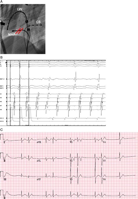 Fever Induced Atrial Flutter Associated With Scn A Mutationa First