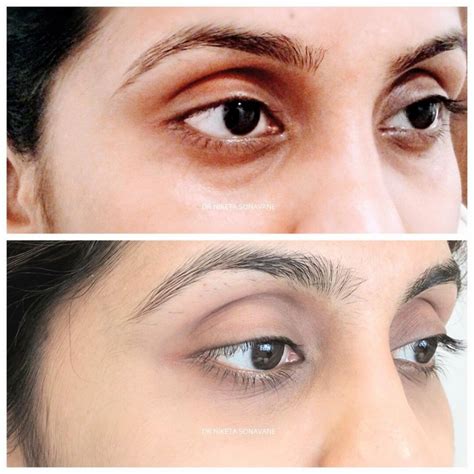Dermal Fillers In Mumbai Cost Before After Side Effects Discount