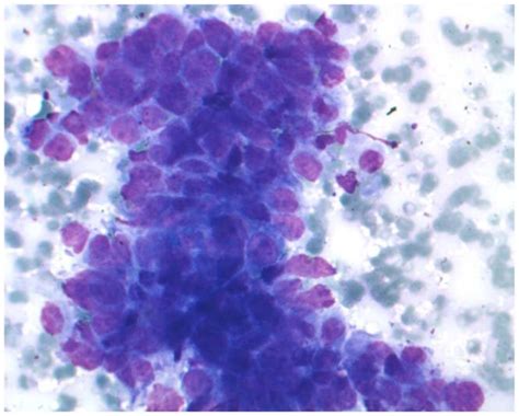 Mediastinal Lymph Node Cytology Of A Nsclc Patient Microscopical