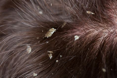 Focus on the same areas that you put the vinegar solution on. Dandruff vs. Head Lice - Lice Clinics of America