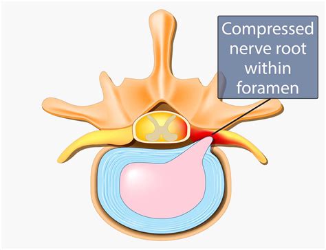 Spinal Narrowing Foraminal Narrowing Spinal Stenosis Stenosis Hot Sex