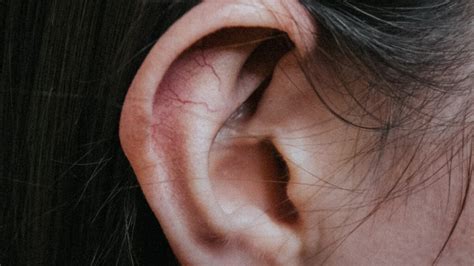 Psoriasis Ear How To Treat It With Natural Remedies Thewellthieone