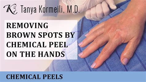 Removing Brown Spots By Chemical Peel On The Hands Youtube