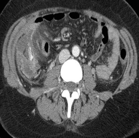 Ct Evaluation Of A Perforated Appendicitis Eurorad