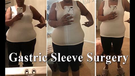 Weight Loss Surgery Sleeve Before And After Blog Dandk