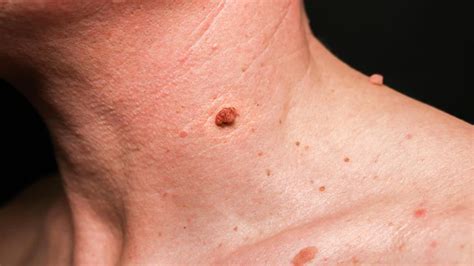 Types Causes And Treatment For Birthmarks