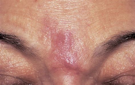 Subcutaneous Nodules On The Face—quiz Case Dermatology Jama
