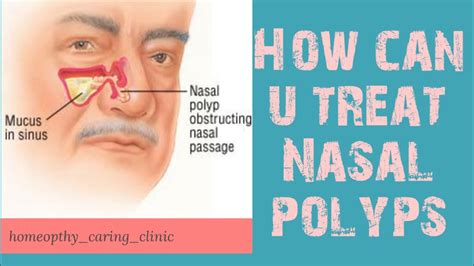 Nasal Polyps What Are Nasal Polyps Signs Symptoms And Treatment