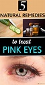 5 Natural Remedies To Treat Pink Eyes - Remedies Lore