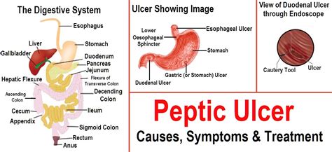 Stomach Ulcer Gastric Ulcer Overview Signs And Symptoms Causes Images