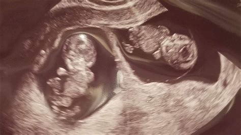 39 Weeks Pregnant Ultrasound