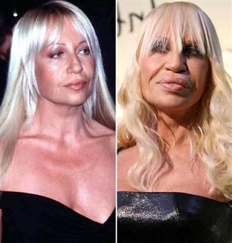 Images About Oh My Botox Gone Bad Some Good On Pinterest Plastic Surgery Gone Wrong