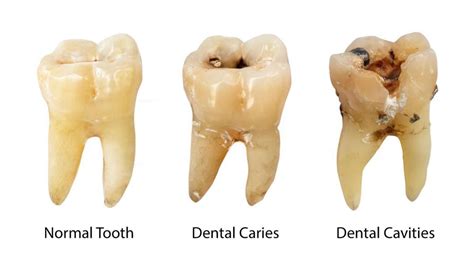 I Have A Hole In My Tooth And It Hurts 3 Best Solutions