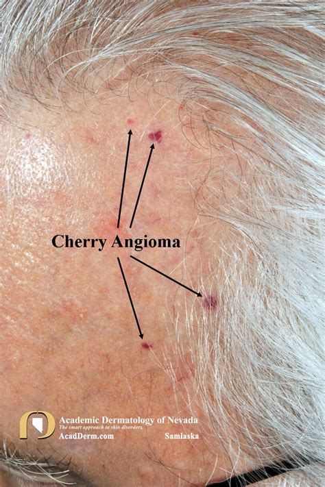 Cherry Angioma On Lip Removal Cherry Angioma Removal Total Body Laser And Med Spa Cherry
