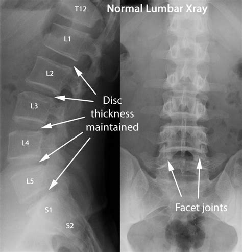 Three to five pictures are usually taken to see the entire lumbar spine, depending on your doctor's request. 17 Best images about X-Ray Lumbar on Pinterest | Addiction ...