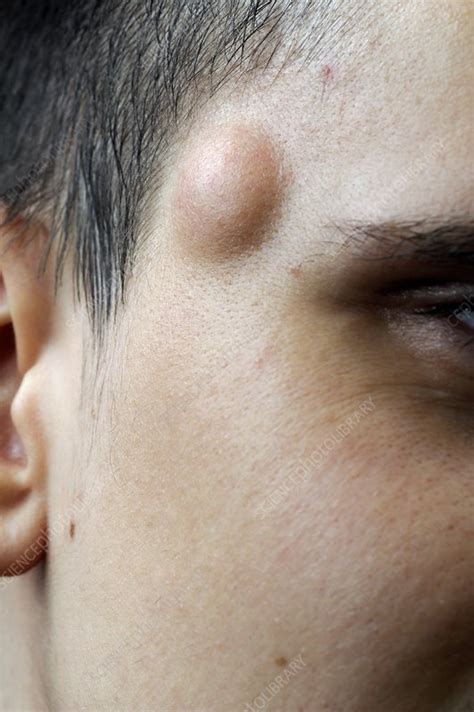 Sebaceous Cyst On The Face Stock Image C Science Photo
