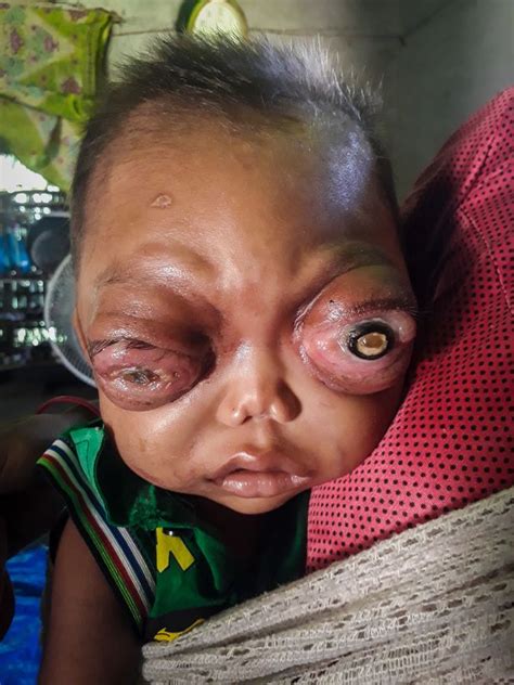 Rare Disorder Leaves Boy 2 Left With Huge Protruding Eyes Which Could