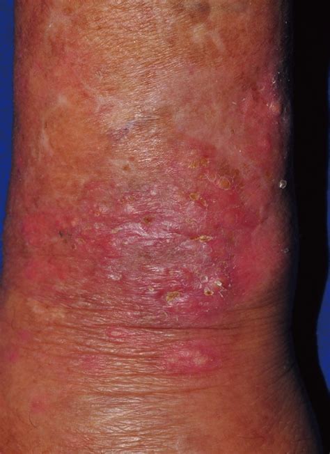 Erythematous Nodular Lesion With Crust Is Seen On The Left Wrist
