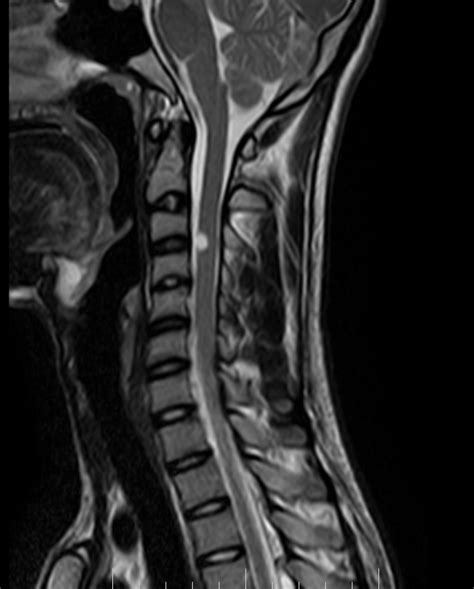 Neurenteric Cyst Mri Sumers Radiology Blog