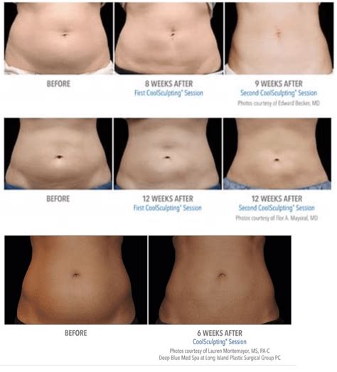 Coolsculpting On Abdomen Purelee Redefined Medical Aesthetics
