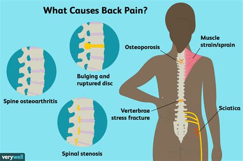Rückenschmerzen Ursachen Behandlung und Zeitpunkt des Arztbesuchs