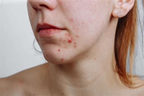 What Is Fungal Acne Reviva Labs