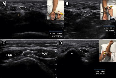 Normal Ulnar Nerve And Ulnar Artery Artery Denoted In Cross Section