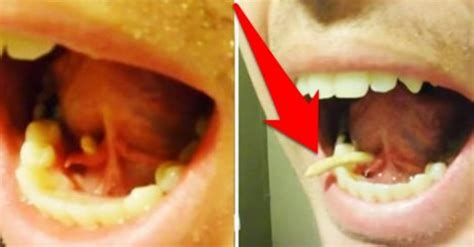 Swollen Salivary Gland Under Tongue
