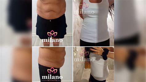 How Long A Tummy Tuck Abdominoplasty Surgery Take Milano Clinic