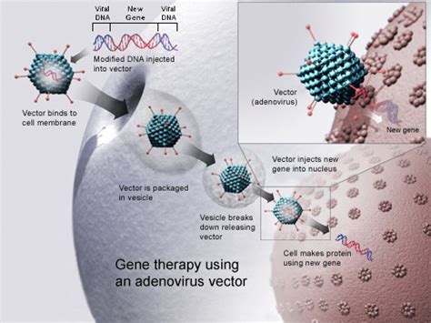 Gene therapy - Wikipedia