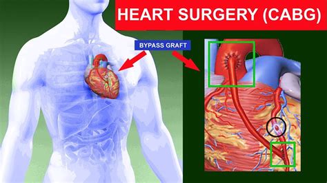 Heart Surgery Coronary Artery Bypass Graft Cabg Youtube