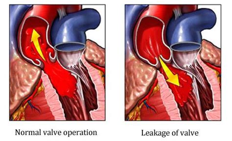 Aortic Regurgitation Heart And Vascular Care New Jersey