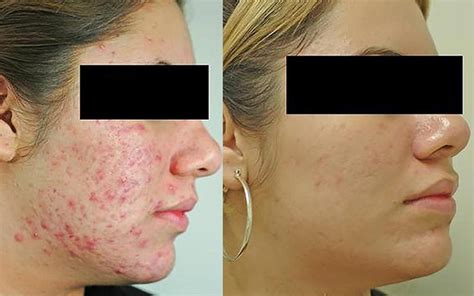 Before And After Photos Of Skin And Acne Treatments Reader S Digest