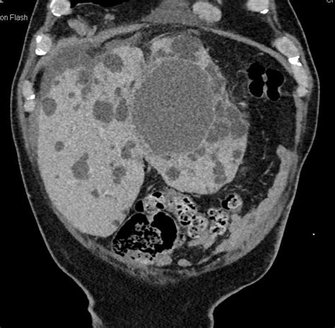 Polycystic Kidney Disease And Polycystic Liver Disease Kidney Case