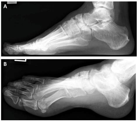 Osteoarthritis Of The Talonavicular Joint With Pseudarthrosis Of The