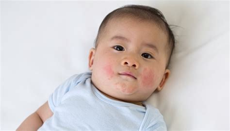 Drool Rash Vs Eczema How To Tell The Difference