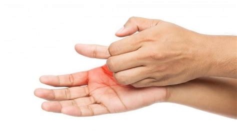 Telapak tangan yang gatal biasanya disertai sensasi panas. Ketahui Penyebab Telapak Tangan Sering Gatal dan Panas ...